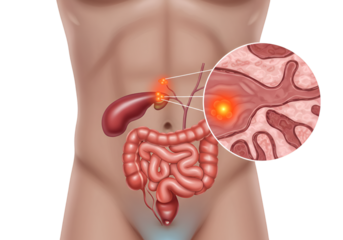 Medical illustration depicting pancreatic cancer, highlighting the affected organ and its location within the abdomen.