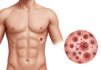 Medical illustration depicting a human torso with a magnified view of viral infection.