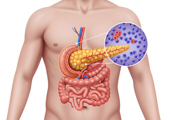 Human anatomy illustration highlighting the pancreas with magnified view of pancreatic cells.