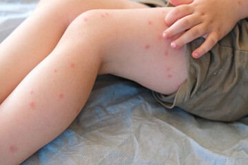 Child scratch body has sensitive itchy skin. Bodily rash. Kid allergy closeup. Little baby scratches eruption. Irritation, hive. Pruritus. Mosquito insect bite. Red from sunburn, Seborrheic Dermatitis