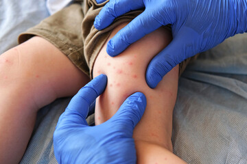 Doctor examining child with bodily red rash. Kid allergy closeup. Little baby scratches an...