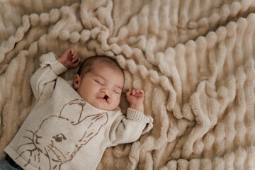 Sleeping Baby with Cleft Lip on Soft Blanket
