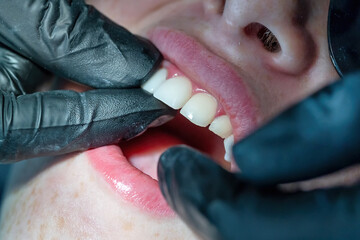 Close-up of ceramic veneers being placed on front teeth. Concept of perfect smile, beauty, dental...