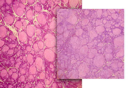 Detailed microscopic view of tissue, exhibiting  a marbled pattern.  Pink,  lilac, and beige tones.  Two sections