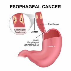 Esophageal Cancer medical flashcard illustration