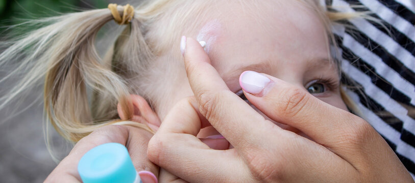 Applying Cream to Child Forehead Insect Bite