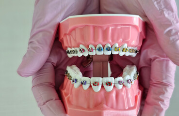 Dental demonstration showing a model of teeth with colorful braces held by gloved hands