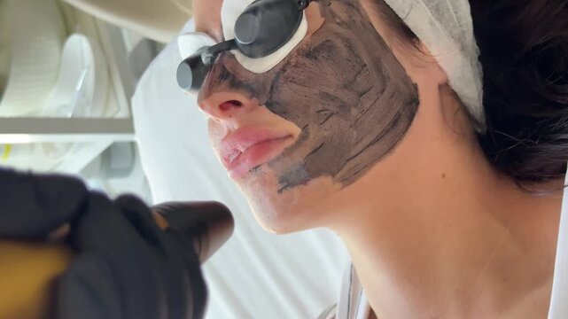 Young woman getting carbon laser facial at beauty clinic. Professional skincare treatment for deep pore cleansing, acne reduction and skin rejuvenation. Modern cosmetology procedure.