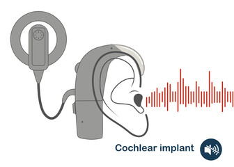 Cochlear implant device electrically stimulates nerve. Ear sound wave adults and children hard middle exam. World Deaf Day in last Sunday of September. Flat vector illustration