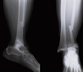 x ray of a broken foot cominutive fracture on tibia and fibula	