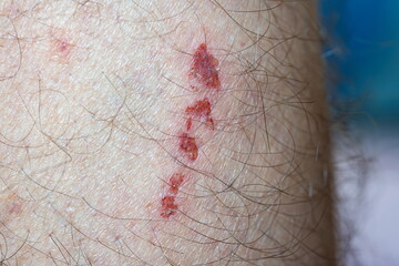Skin bruise or abrasion wound on a Caucasian male's leg. Close up shot, hairy leg
