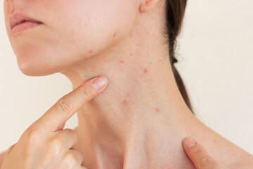 Close-up profile of a young woman suffering acne in acute stage on her neck. Skin diseases....