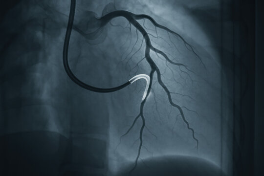 Angiogram of coronary arteries with stent placement - Photo