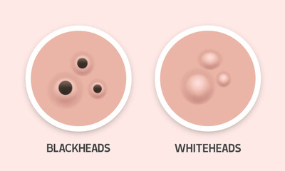 Blackheads and whiteheads illustration. Types of acne. Vector 3d illustration