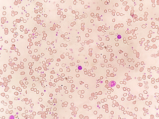 Hematological study: Abnormal structural  RBC with thrombocytosis.