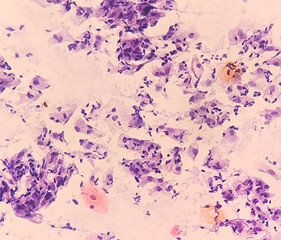 Paps smear: NILM with fungal infection caused by candida species.