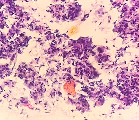 Paps smear: NILM with fungal infection caused by candida species.