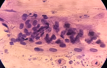 NILM (Negative for Intraepithelial Lesion or Malignancy) with endometrial cells under microscopy, Pap's smear.