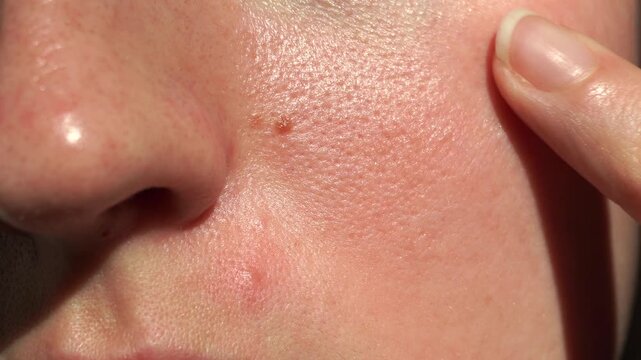 Macro close-up of real human skin with visible pores, redness, and natural texture. Finger gently touching cheek. Perfect for dermatology, skincare ads, and educational medical content.