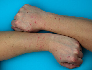 Fresh wound and blood from a bite cat.