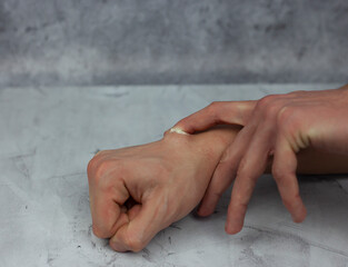 Applying ointment on the hematoma. Hematoma treatment.