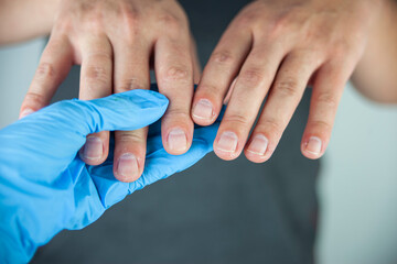 Fungus, close up fungal nail infection on fingers. Fungal infection of the nail. health care.