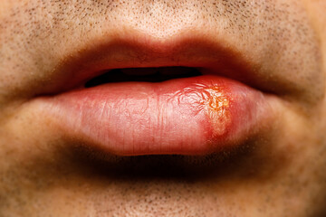 Close-up of herpes on male lip with cold sore blister