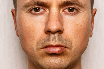Portrait of man with herpes on lip