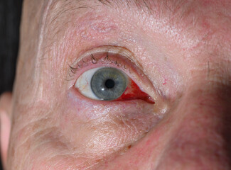 Subconjunctival hemorrhage, broken blood vessel in the eye, severe redness