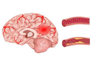 Cerebrovascular disease, stroke, brain, blood vessel blockage