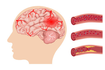 Brain damage, cerebrovascular disease, brain injury, stroke, blood flow disorder