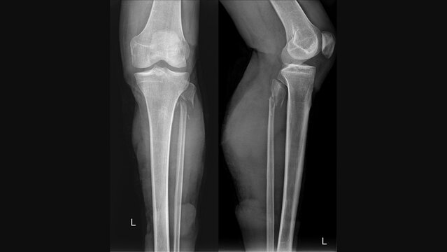 X-ray of left leg showing fibula bone fracture – AP and lateral views