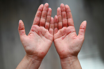 Close-up of human palms with red rash caused by Coxsackievirus, showing hand-foot-mouth disease...