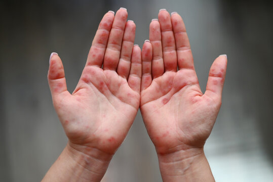 Close-up of human palms with red rash caused by Coxsackievirus, showing hand-foot-mouth disease symptoms.