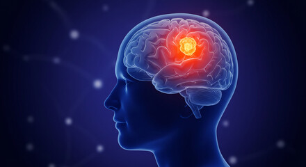 Brain Tumor Medical Illustration Highlighting Cancerous Growth for Awareness and Research