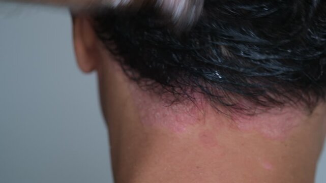 Is it permissible to dye hair on a scalp that is suffering from Psoriasis?