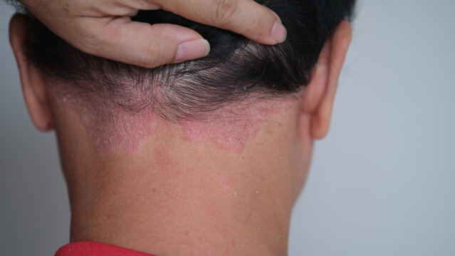 Is it permissible to dye hair on a scalp that is suffering from Psoriasis?