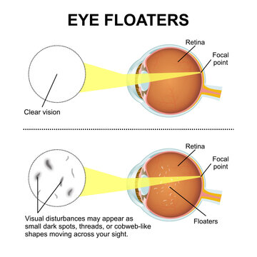 Eye Floaters flashcard medical eye illustration