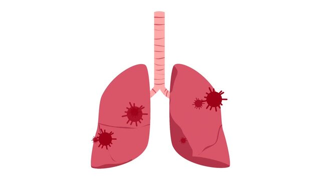 Pneumonia. Lung disease illustration animation. Respiratory disease