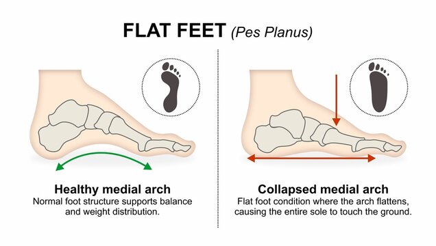 Flat Feet (Pes Planus) foot flashcard illustration