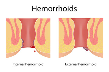 Two types of hemorrhoids. Internal and external. Medical illustration, treatment