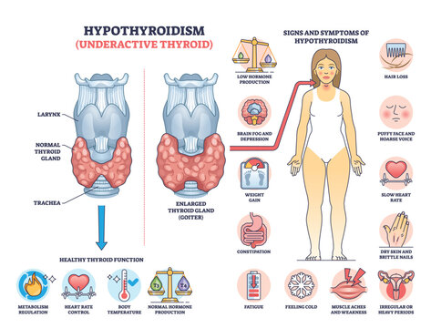 Hypothyroidism is shown with a thyroid gland diagram, symptoms, and hormone imbalance. Key objects, thyroid gland, hormone icons, symptom chart. Outline diagram