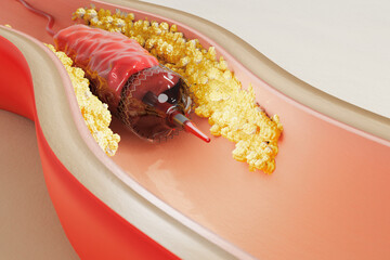medical illustration of a stent being deployed in a narrowed artery, surrounded by cholesterol plaque.  procedure to restore proper blood flow and treat coronary artery disease. 3d render.