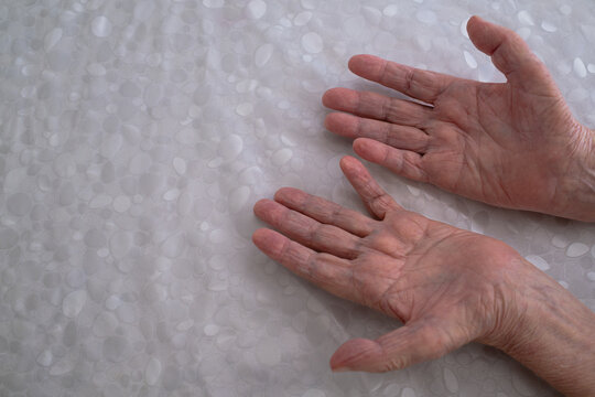 Elderly man showing hands affected by neuromuscular disease.