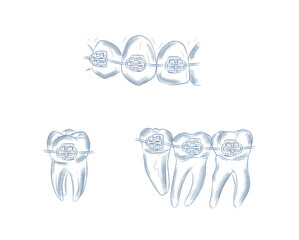 Teeth with braces set illustration drawing in graphic style with blue on white background.