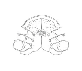 Orthodontic align teeth plate illustration drawing in graphic style with black on white background.