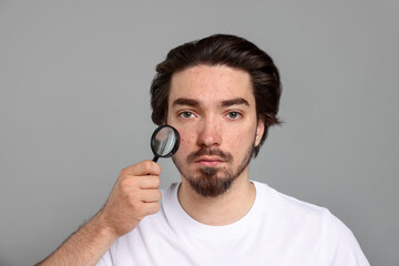 Young man with acne problem holding magnifying glass near his face on light grey background