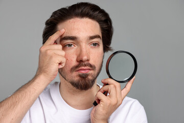 Young man with acne problem holding magnifying glass near his face on light grey background