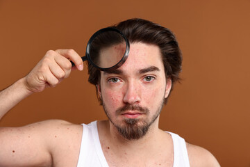 Young man with acne problem holding magnifying glass near his face on brown background