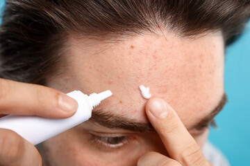 Young man with acne problem applying cream onto his face on light blue background, closeup